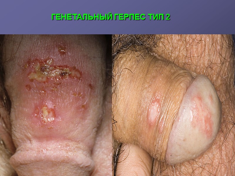 ГЕНЕТАЛЬНЫЙ ГЕРПЕС ТИП 2